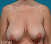 Patient # 99262 Before Photo # 1